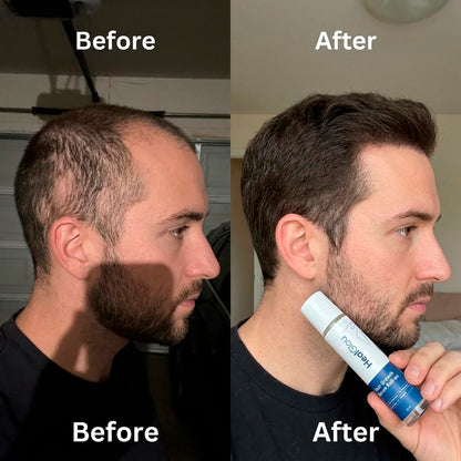 HealGlou HairRevive™ Roll on System